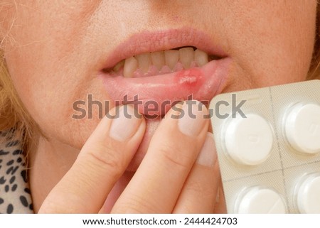 stomatitis in mouth closeup, close-up on the lip with aphthous stomatitis, treatment of inflammation of the oral mucosa, closeup Royalty-Free Stock Photo #2444424703