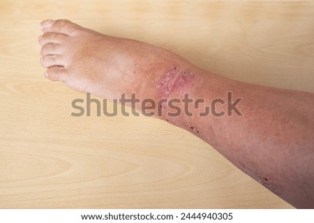 closeup weeping wounds, venous ulcers on female leg, diabetes mellitus, varicose veins, healing ulcers by destroying growth factors, eliminating inflammatory process, sanitation pathogenic microflora Royalty-Free Stock Photo #2444940305