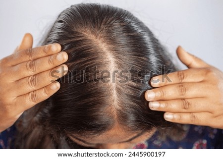 young female showing symptoms for hair fall and touching her balding scalp
