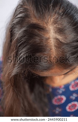 hair falling, closeup shot of a women showing her balding head suffering from hair loss