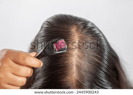 women using dermaroller for collagen induction therapy to treat androgenetic alopecia