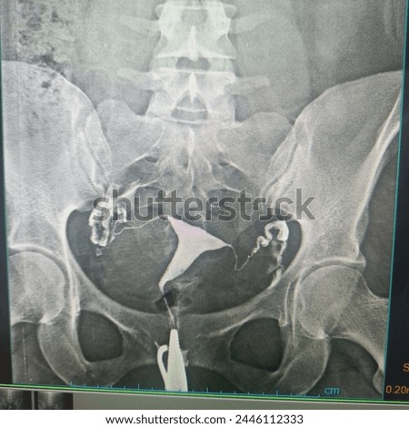 Hysterosalpingography (HSG) is an X-ray procedure that is used to view the inside of the uterus and fallopian tubes. It often is used to see if the fallopian tubes are partly or fully blocked.  Royalty-Free Stock Photo #2446112333