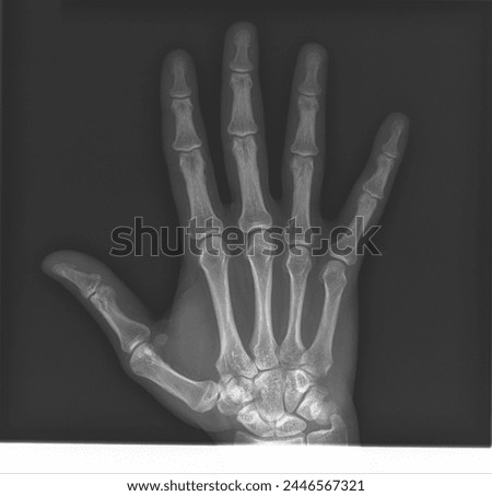 The X-ray Image of a Male Human Normal Hand and Fingers