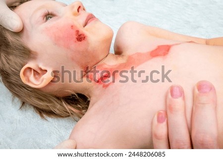 medical procedure dressing a boy with a first-degree burn from boiling water on his face, neck and chest Royalty-Free Stock Photo #2448206085