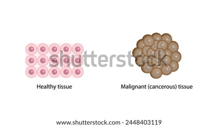 Healthy tissue and Malignant (cancerous) tissue. Cancer disease development. Malignant tumor. Medical biological, scientific vector illustration.	