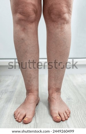 Understanding Lower Limb Alignment,Anatomical Considerations for Health Care Professionals in Assessing Genu Varum and Bowed Feet Royalty-Free Stock Photo #2449260499
