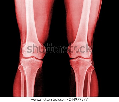 Knee x-ray red colur