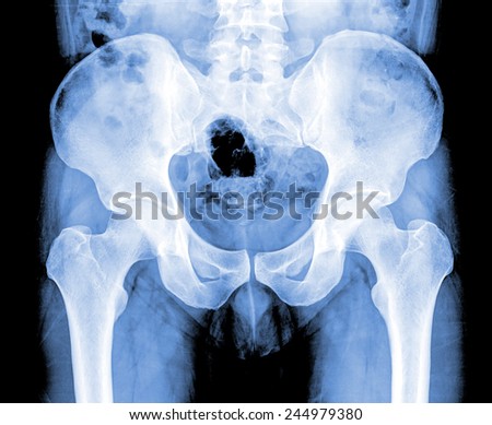 x-ray of hip , blue color