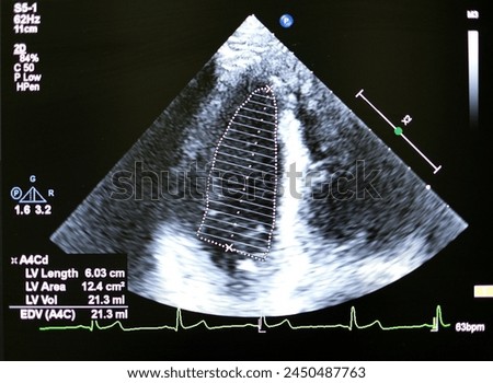 The echocardiogram show Modified Simpson’s rule (the biplane disk summation approach) for estimating LV volumes, ejection fraction, and mass Royalty-Free Stock Photo #2450487763