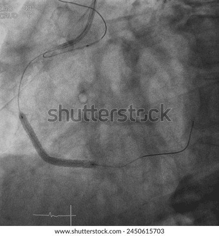 X ray image showed drug eluting stent (DES) deployment at right coronary artery (RCA) with balloon catheter inflation at conus branch for anchoring technic in percutaneous coronary intervention (PCI). Royalty-Free Stock Photo #2450615703