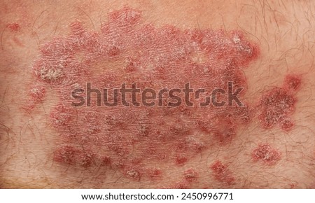 Fungi Coccidioides immitis, saprophytic stage, live photo showing
allergies of Valley fever,Pathogenic fungi that reside in soil and can cause infection coccidioidomycosis, or Valley fever,C immitis
 Royalty-Free Stock Photo #2450996771