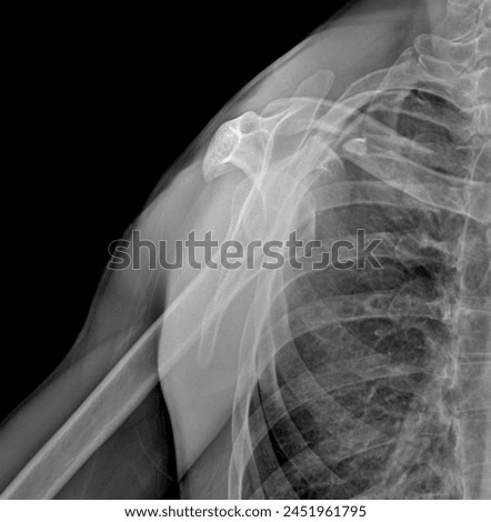 The transcapular y view x-ray is taken. In the picture you can see the clavicle bone fracture