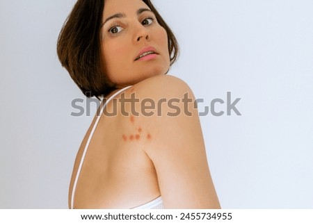 A woman with her shoulder bitten by a bedbug on a white background, close-up. Skin health problem. Red pimples