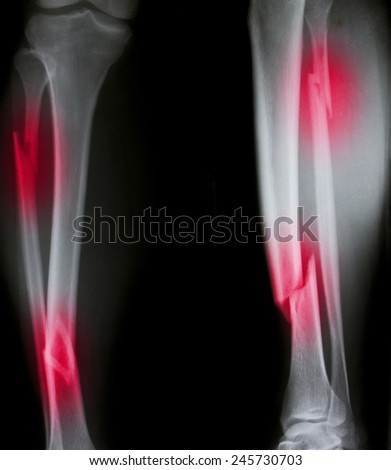 X-ray of both human legs (broken legs)