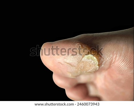 Toe skin disease. Dry cracked feet.
Dry feet skin crack off. Foot skin problem