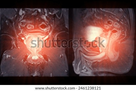 MRI of the prostate gland, revealing an enlarged size, aids in diagnosing tumors, guiding treatment decisions, and monitoring prostate health. Royalty-Free Stock Photo #2461238121