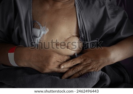Medical concept: Close up picture of the patient's hand cancer survivor showing mastectomy scar