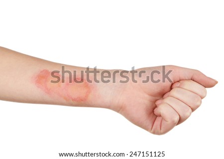 Horrible burns on female hand isolated on white Royalty-Free Stock Photo #247151125