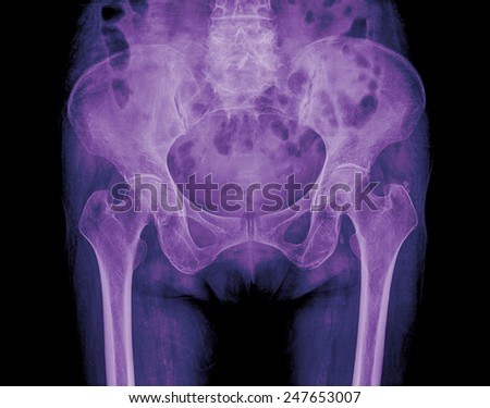 x-ray of hip