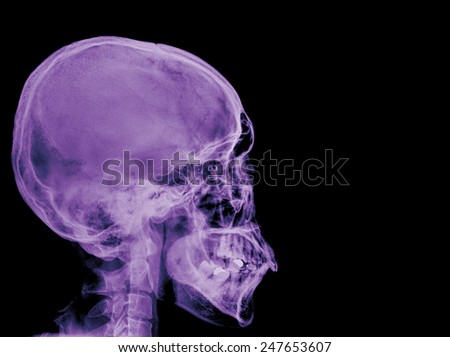 X-ray Skull ( Skull Lateral )