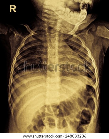 Chest x-ray film of children