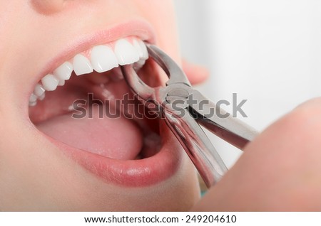 Removing the sick tooth from girls mouth Royalty-Free Stock Photo #249204610