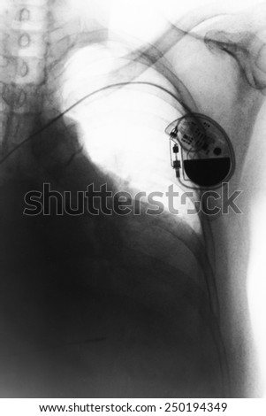 chest with the pacemaker on x-ray film