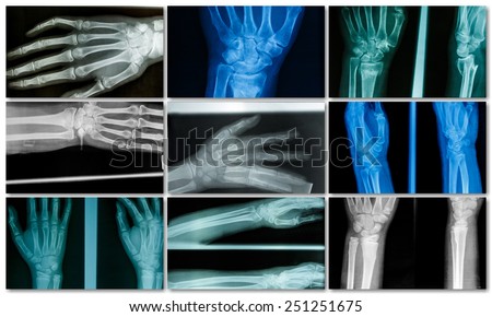 Collection film xray imaging of adult patient hand with normal anatomy and broken bone