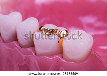 Gold Inlay on model Fitted 3 of 3 photos Royalty-Free Stock Photo #25133569