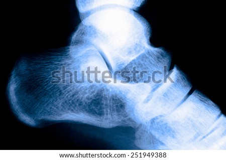 X-ray pictures of blue ankle bone.