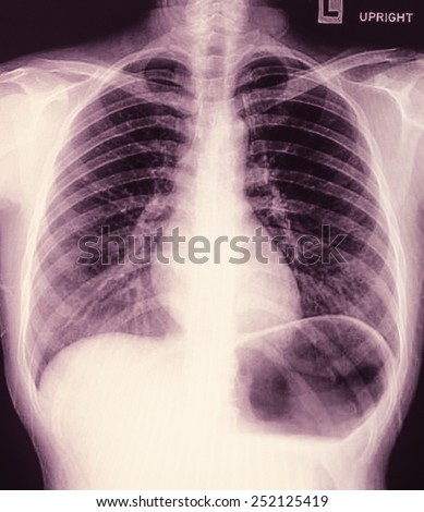 X-Ray Image Of Chest for a medical diagnosis