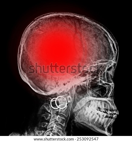 "Stroke" (cerebrovascular accident). Film x-ray skull lateral with stroke 