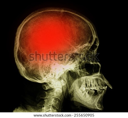 "Stroke" (cerebrovascular accident). Film x-ray skull lateral with stroke