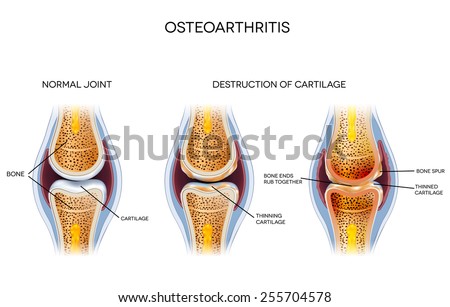 Osteoarthritis, destruction of cartilage. Healthy joint and unhealthy joint anatomy.