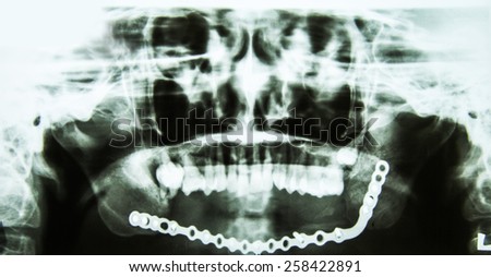 X-ray of teeth, stomatology concept