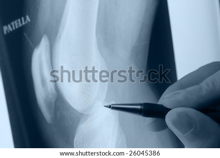 pen showing X-ray picture of knee joints on screen