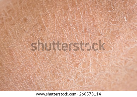 Macro dry skin (ichthyosis) detail Royalty-Free Stock Photo #260573114