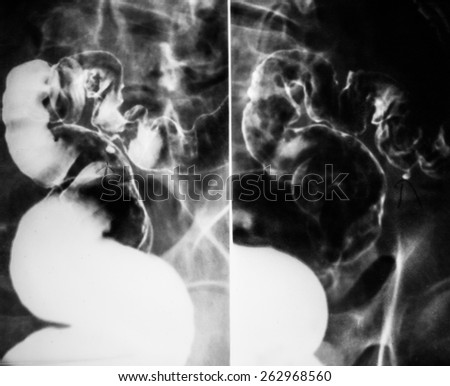 x-ray of intestinal abdominal