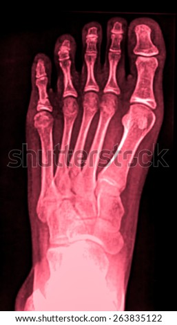 Colection x-ray of foot
