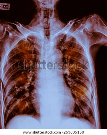 film chest x-ray show fibrosis & interstitial & patchy infiltrate at both lung due to Mycobacterium tuberculosis infection (Pulmonary Tuberculosis)
