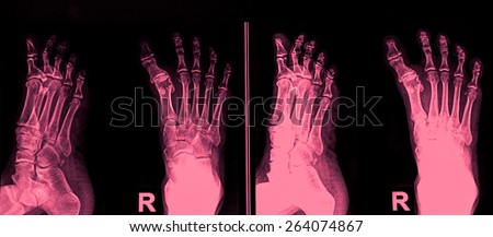 X-RAY of foot