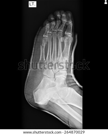 x-ray of foot