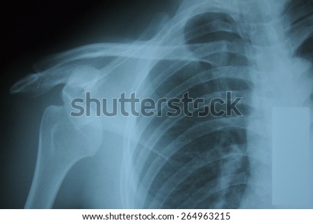 X-ray film image dislocation.