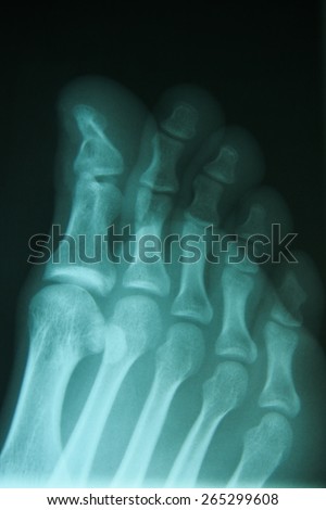 film x-ray show fracture toe bone at first toe.