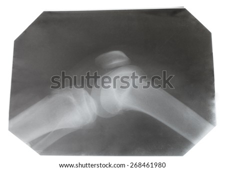X-ray picture of human knee joint isolated on white background
