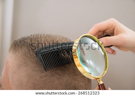 Close-up Dermatologist Looking At Patient's Hair Through Magnifying Glass