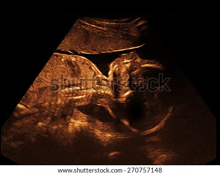 a child in the picture ultrasound