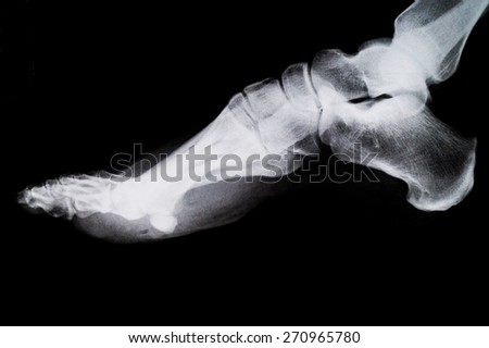 X Ray of the Foot. Bones in the Ankle