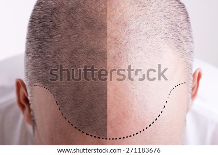 Top view of a men's head with a receding hair line - Before and After Royalty-Free Stock Photo #271183676