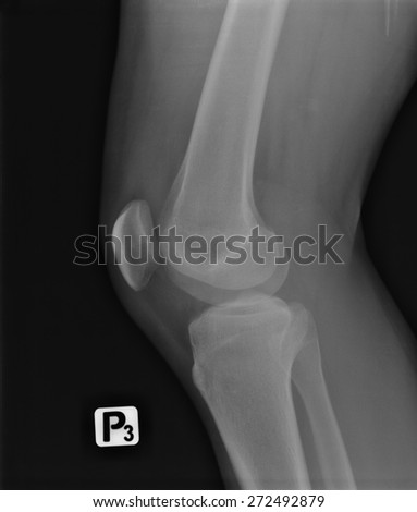 X-ray radiology scanned image of young man leg injury